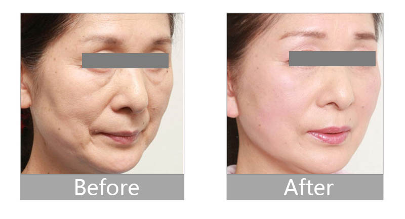 干细胞外泌体与美容抗衰修复